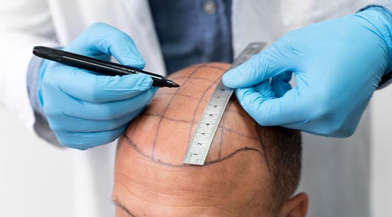 What are Hair Transplantation and Treatment Methods in Turkey?