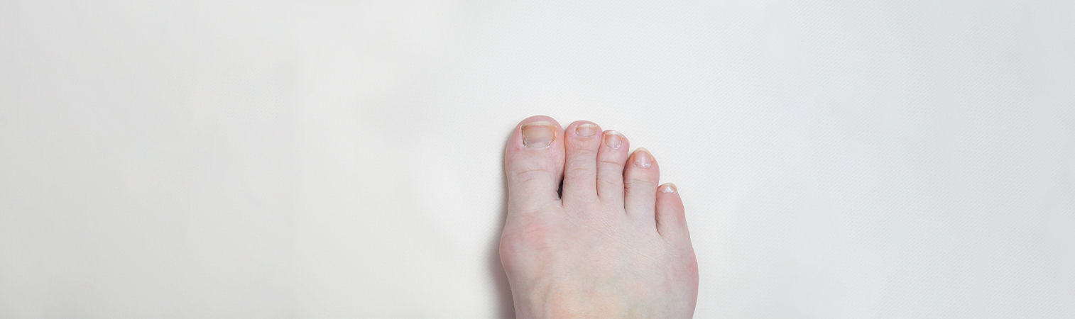 A Brief Description: Bunions