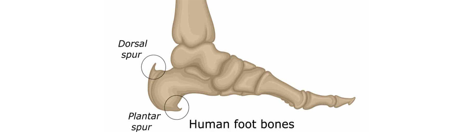 Bone Spurs With All Its Features